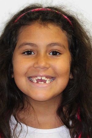 Young girl with uneven smile before orthodontics