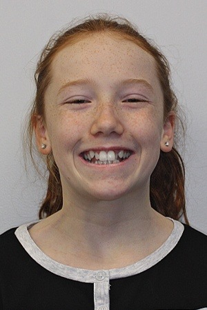 Young girl with misaligned smile before braces