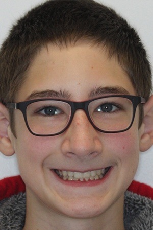 Teen boy with healthy smile after braces treatment
