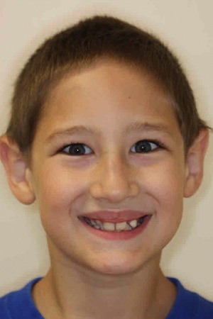 Boy with crooked smile before braces treatment