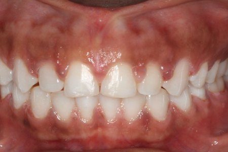 Closeup of smile with evenly spaced teeth after braces