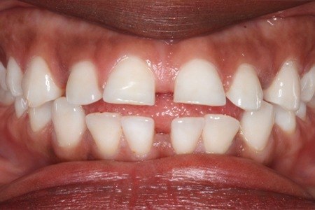 Closeup of smile with gaps between teeth before braces