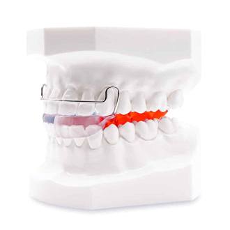 Bionator in Worcester displayed on a model mouth