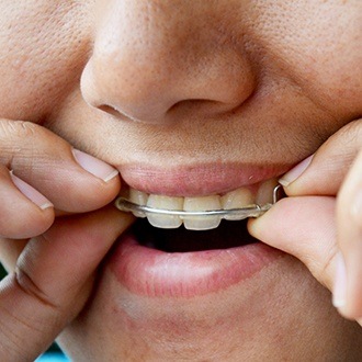 Closeup of patient placing an orthodontic appliance