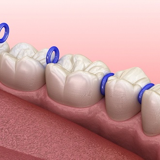 Diagram of dental spacers in Worcester dental separators in Worcester