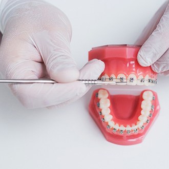 Orthodontist holding model of teeth with braces