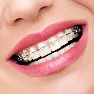 Closeup of teeth with clear and ceramic braces