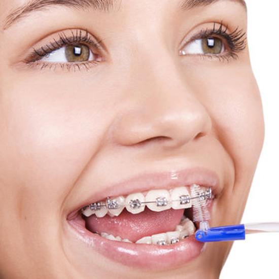 a patient flossing her braces