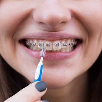 Woman using interproximal brush to clean braces