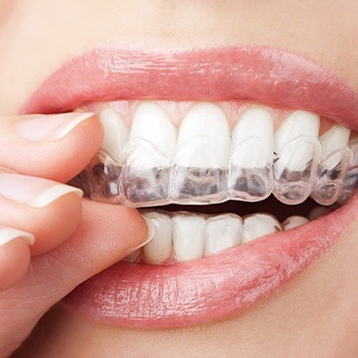 Closeup of patient placing Invisalign tray