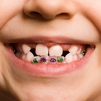 Closeup of child's smile with pediatric braces on bottom teeth