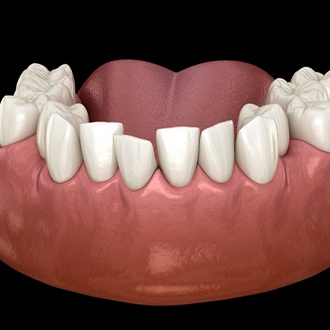 A digital image of overcrowded teeth sitting along the lower arch