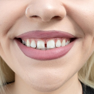 An up-close image of a person’s gapped teeth