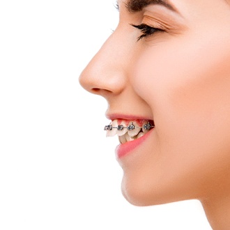 The side view of a person’s teeth who has an overbite but is wearing braces to fix the problem
