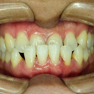 An up-close view of a person’s smile who has an underbite