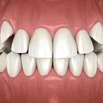 A digital image of impacted canine teeth
